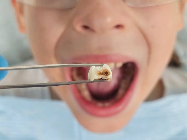 Best Tooth Infection Emergency Dentist  in Raoul, GA